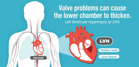 lv overload or aspecific change|is lvh life threatening.